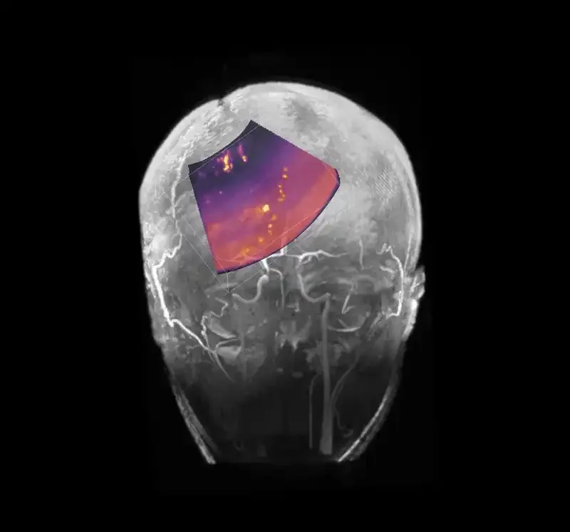 Ultrasound imaging of the brain